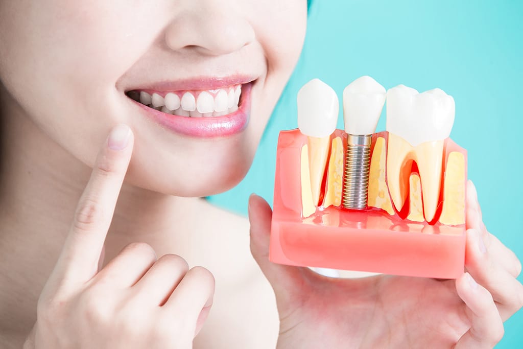 How Do Dental Implants Work