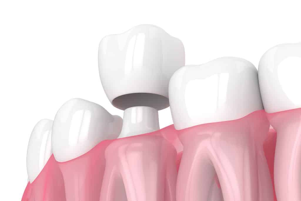 Common Signs That Your Dental Crown May Need Replacing