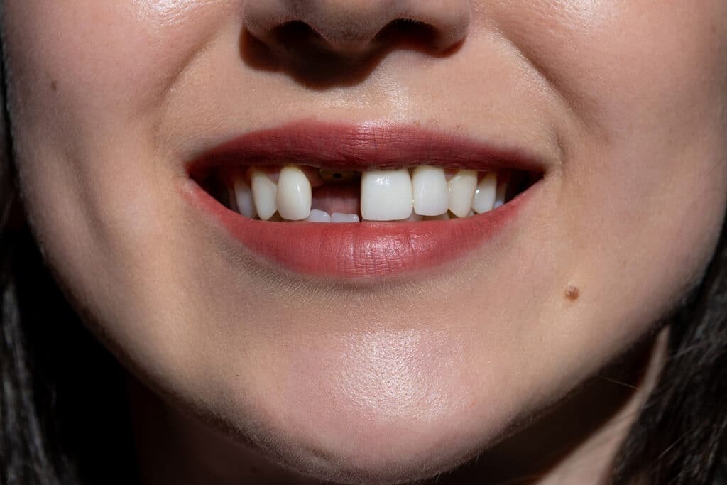 Does a Missing Tooth Always Need to Be Replaced?