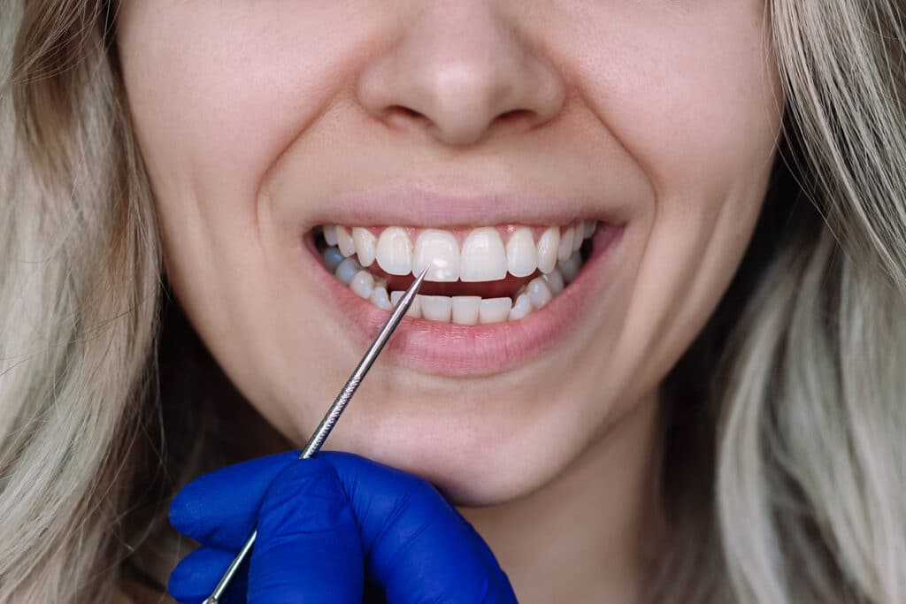 Fluoride Treatments for Adults: Are They Worth It?