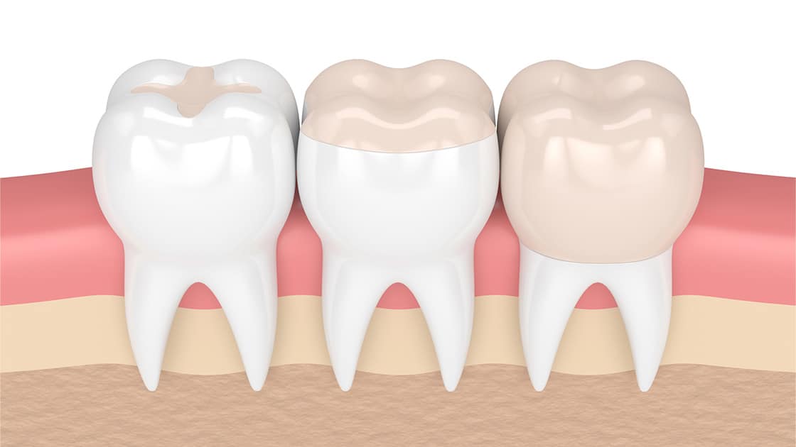 inlay-onlay fillings