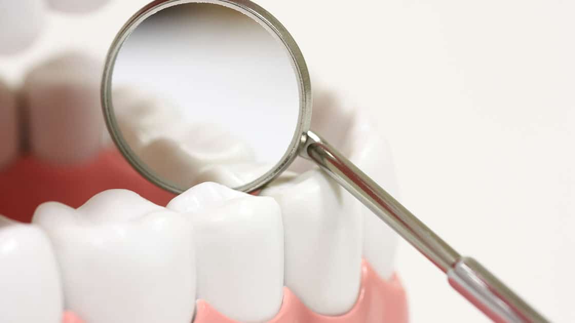 Dental Crowns and Bridges