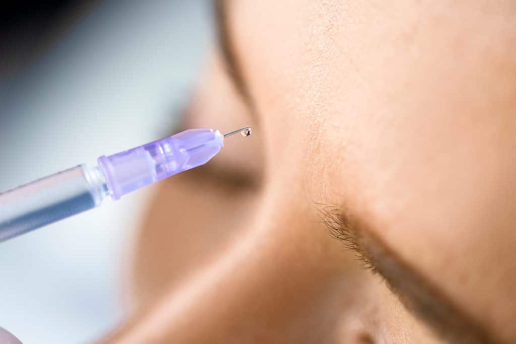 Top 5 Benefits of Dermal Fillers