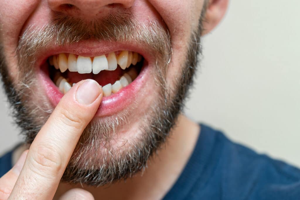 Top 5 Habits That Damage Your Teeth Without You Knowing