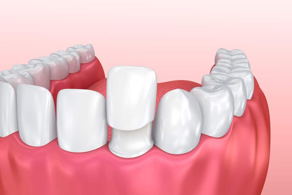 Veneers vs. Bonding: Which Is Right for Your Smile Goals?